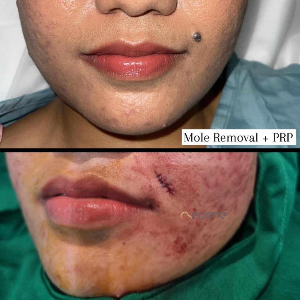 Acne scar treatment