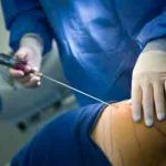 Liposuction