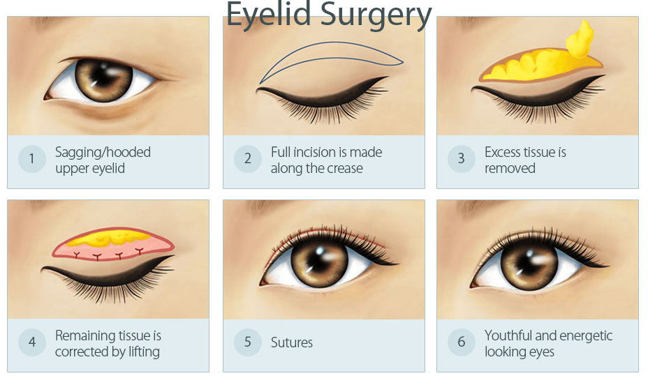 Operasi lipatan mata