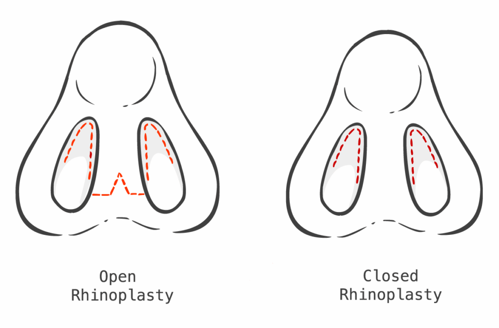 Sayatan rhinoplasty