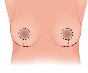 Sayatan Breast reduction