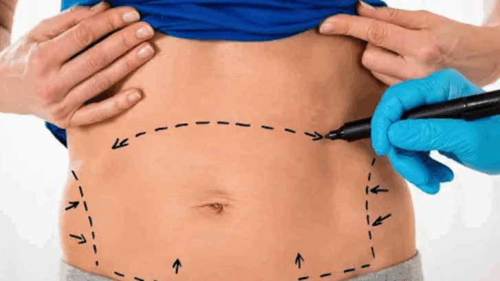 Tummy tuck surgery