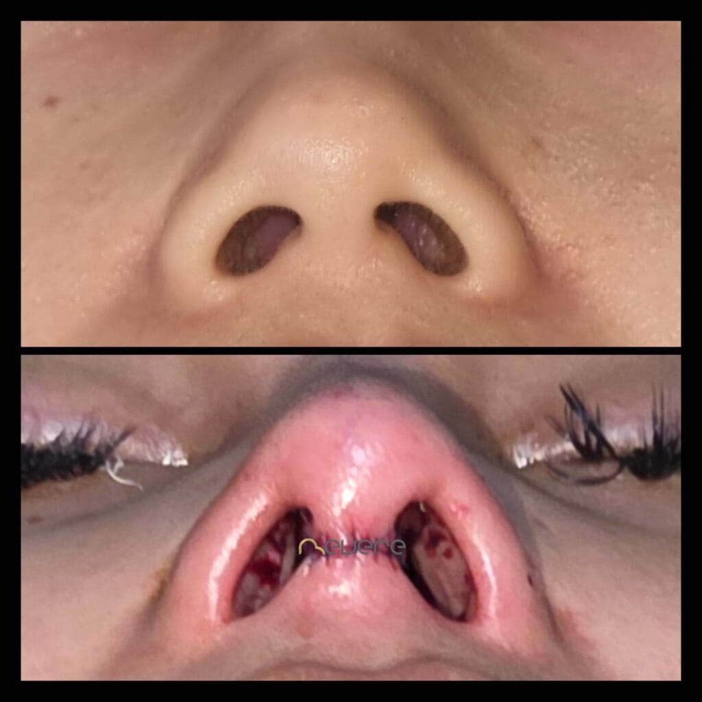 before after rhipnoplasty jakarta