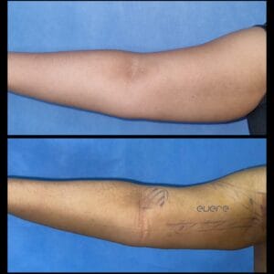 Sedot lemak lengan Liposuction