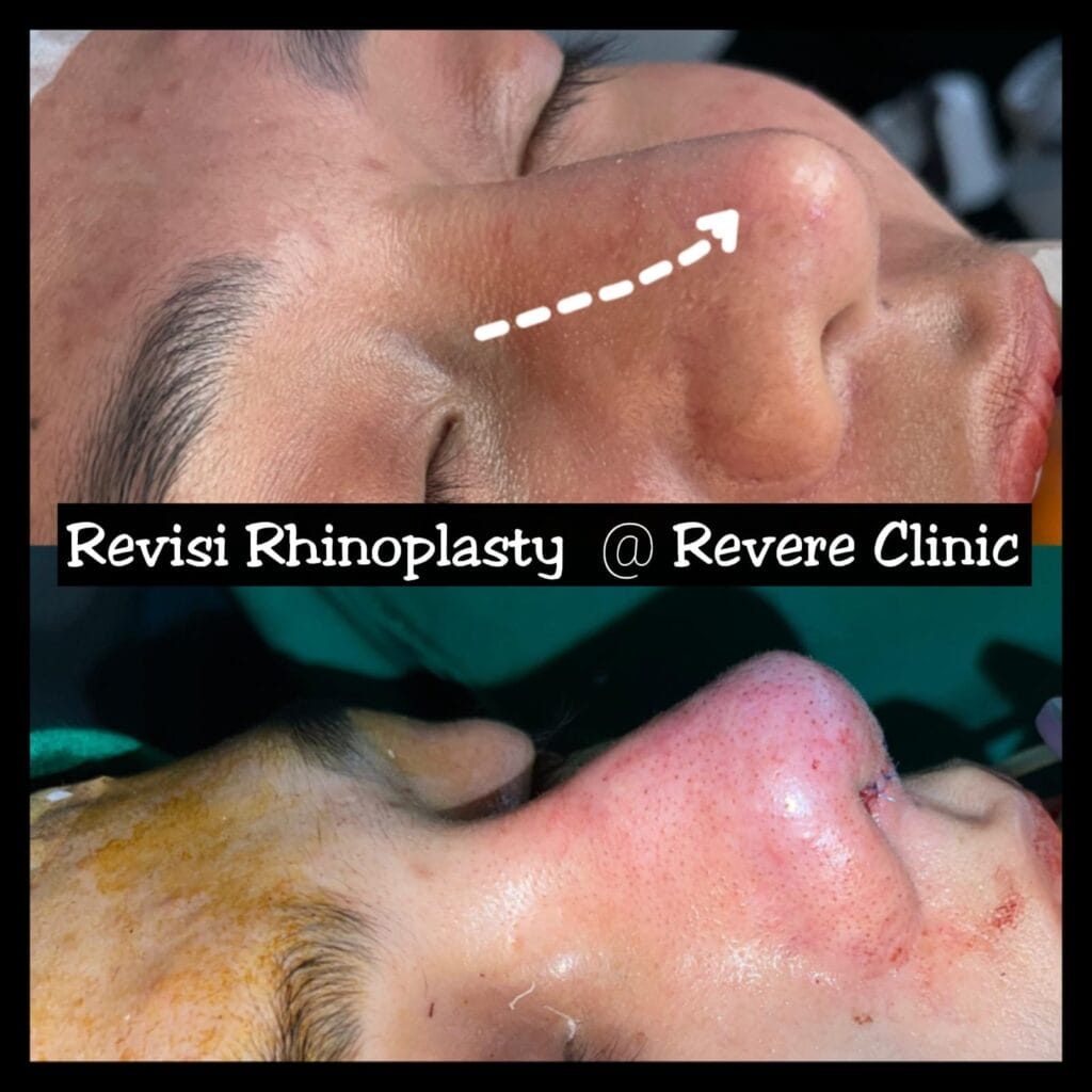 Dokter Rhinoplasty hidung