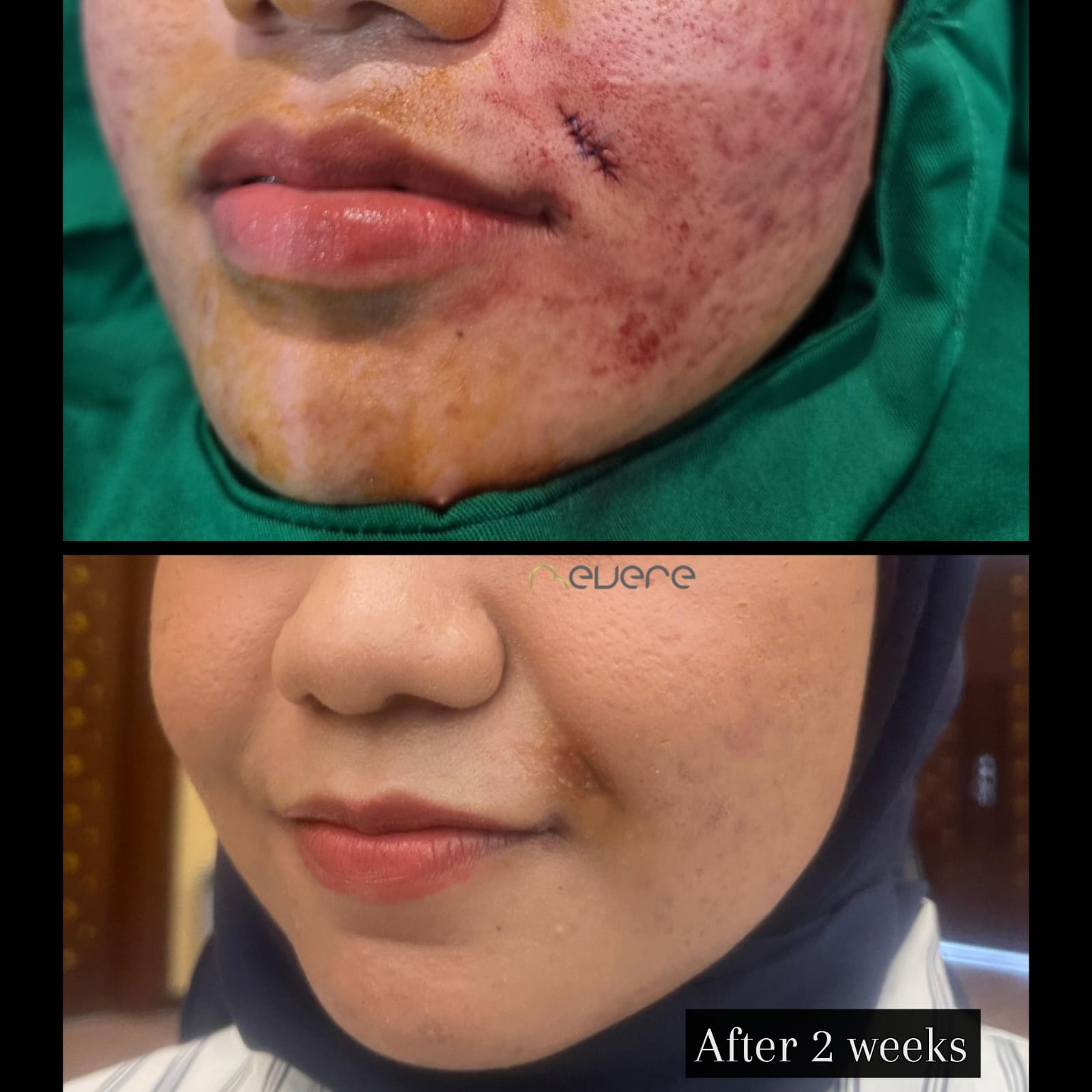 Mole dan acne scar treatment