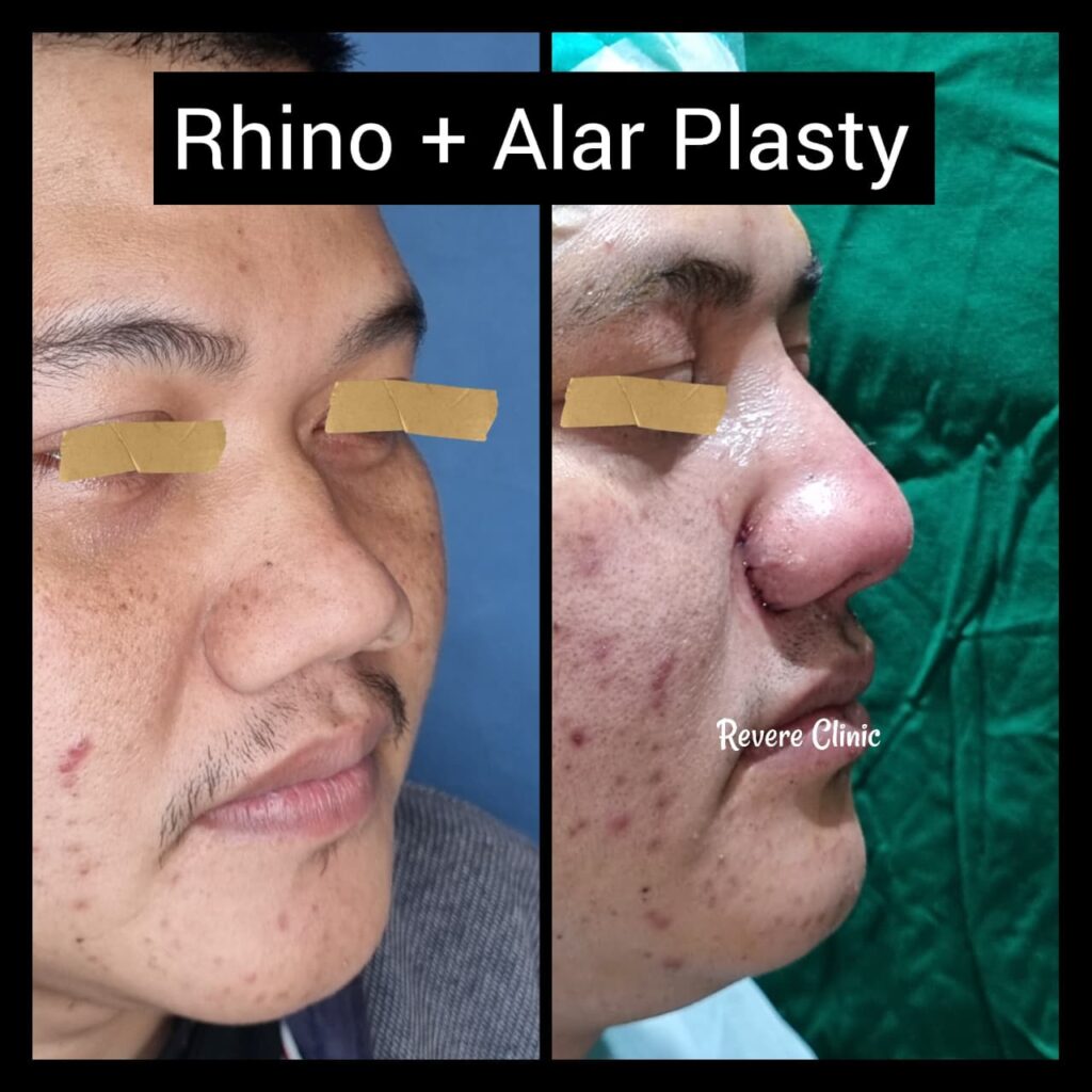 Rhinoplasty Alarplasty