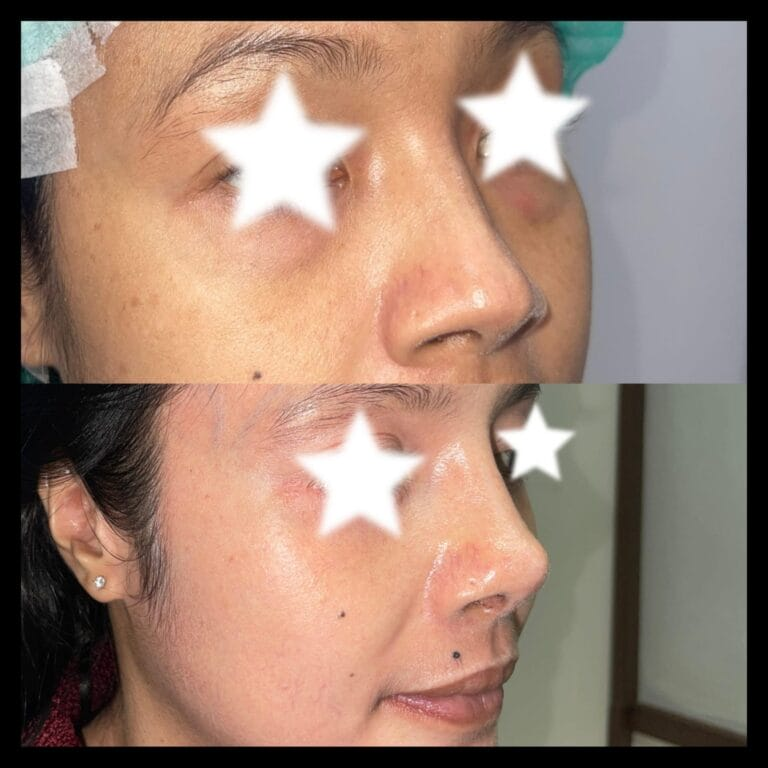 klinik rhipnoplasty jakarta