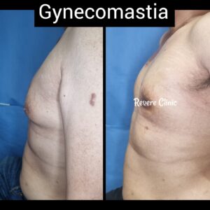 Mengecilkan dada pria Gynecomastia