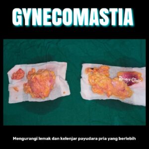 Kelenjar Payudara Pria