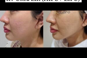 RV Ultra Lift HIFU LIFU Pengencangan Kulit HIFU LIFU