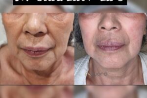 RV Ultra Lift HIFU LIFU before after Pengencangan Wajah HIFU