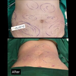 Liposuction Perut