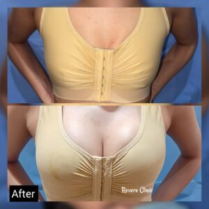 Breast augmentation implant